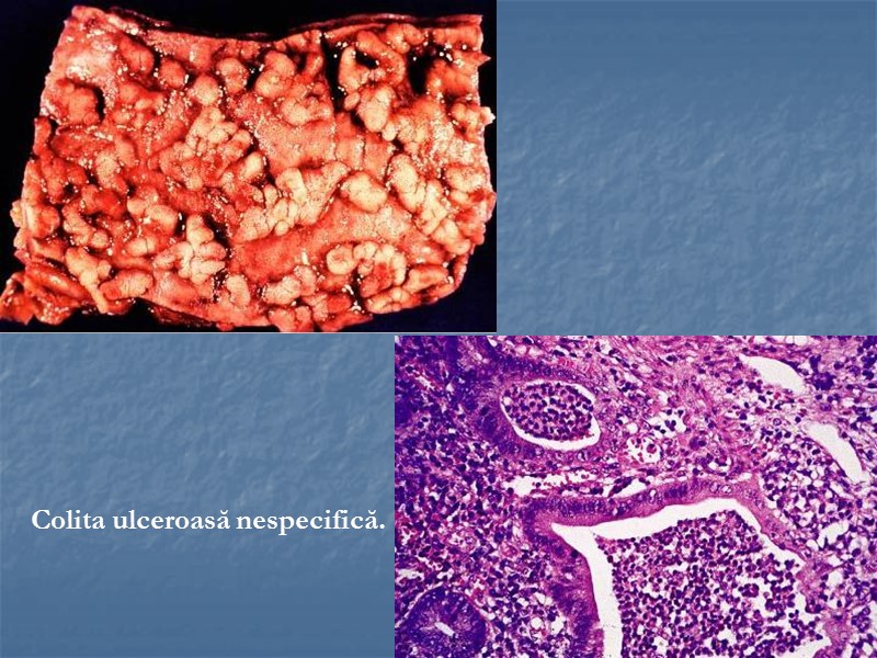 Colita ulceroasă nespecifică.